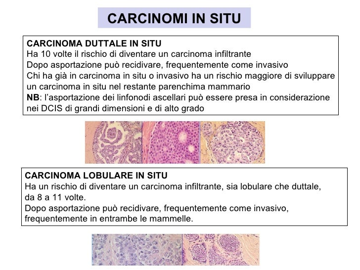 carcinoma lobulare in situ terapia carcinoma lobulare in situ terapia